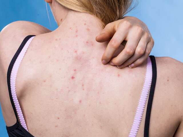 big and painful back acne